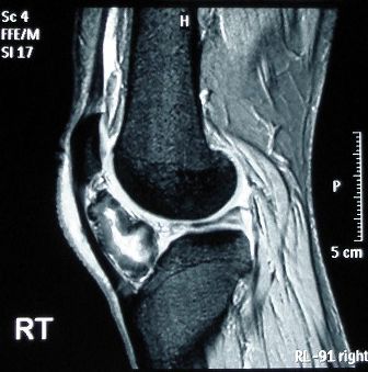 MRI of the knee demonstrating ossification in the peritendinous tissues in a patient with osteochondroma - Wikimedia commons
